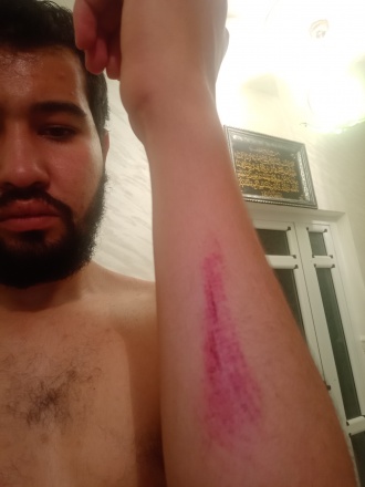 Mustapha Bendjema shows off his injuries