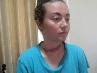 Bethany Rielly's neck injuries