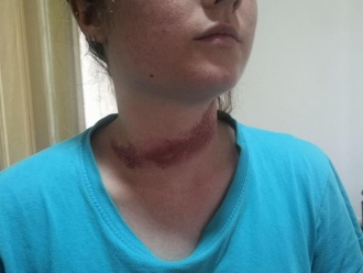 Bethany Rielly's neck injuries, one of the hospitalised activists